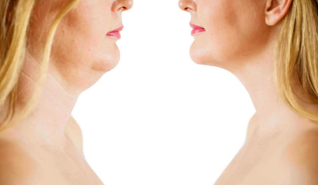 Double Chin treatment Solihull Lodge before and after results