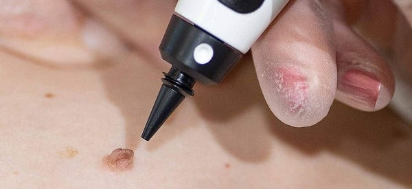 After Skin Tag Removal Solihull Lodge