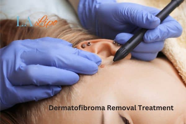 Dermatofibroma Removal Treatment Solihull Lodge