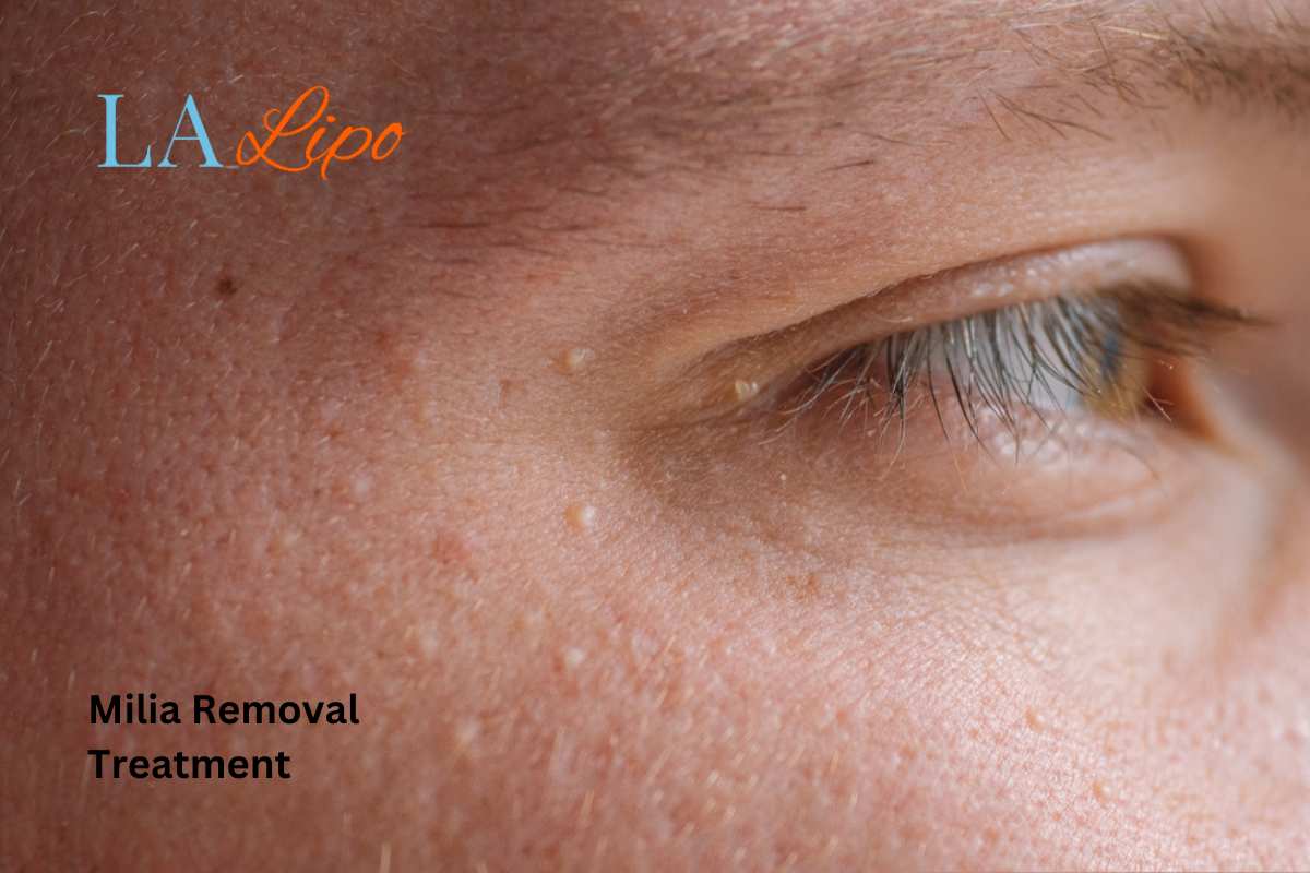 Cryopen Milia Removal: Is It the Easiest and Safest Option Solihull Lodge?