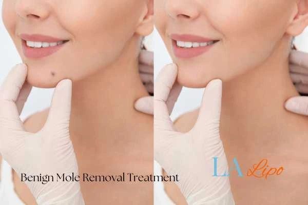woman's before and after mole removal Solihull Lodge results