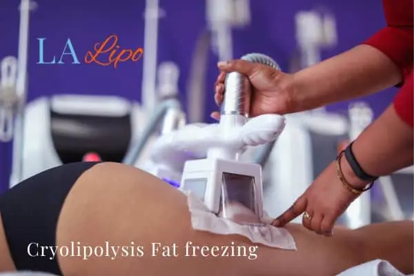 women getting fat freezing Solihull Lodge