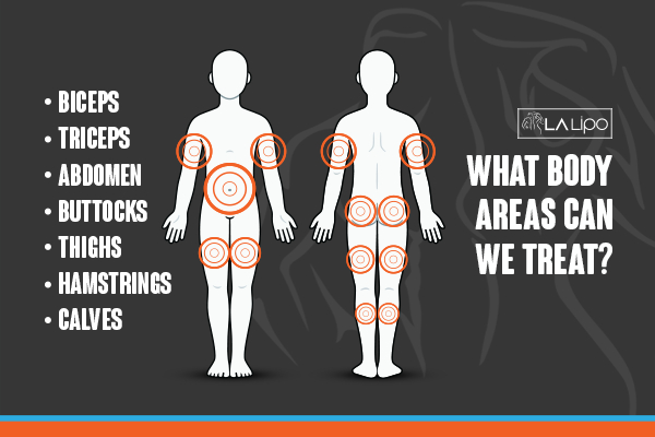 Graphic to show areas you can have LA-EMS Body Sculpting Solihull Lodge treatment.