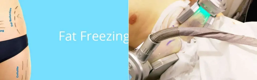 Fat freezing Solihull Lodge on multiple areas of the body