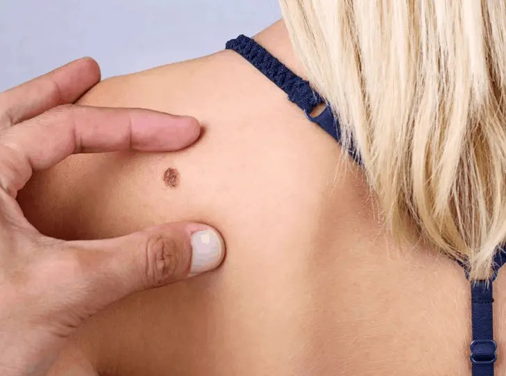 woman having mole removal Solihull Lodge consultation before treatment.