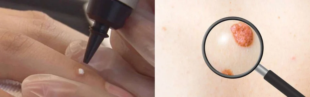 CryoPen practitioner Solihull Lodge assessing a benign mole before treatment