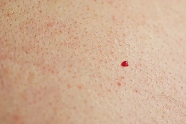 close up of a cherry angioma Solihull Lodge