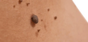 image of a skin tag Solihull Lodge