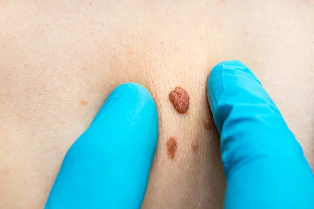 Consultant examining a skin tag Solihull Lodge