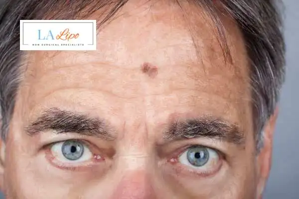 Solar Lentigo Removal Solihull Lodge image of man with mark on his forehead
