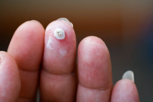wart on person finger - cryotherapy to treat from LA LIPO Solihull Lodge