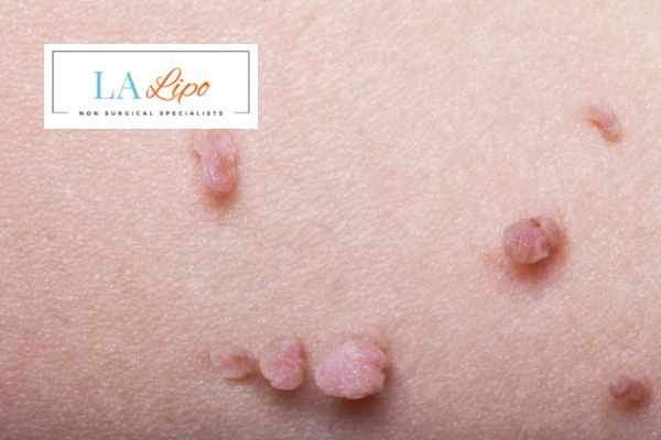 Does cryopen skin tag removal Solihull Lodge hurt? Find out now call our team today!