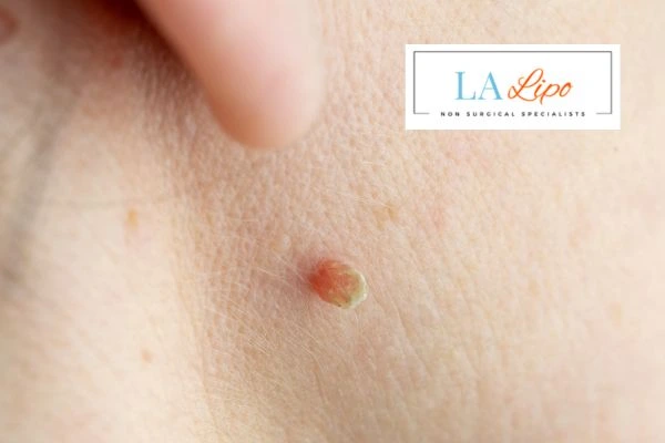 Book skin tag removal Solihull Lodge today speak to our team now!