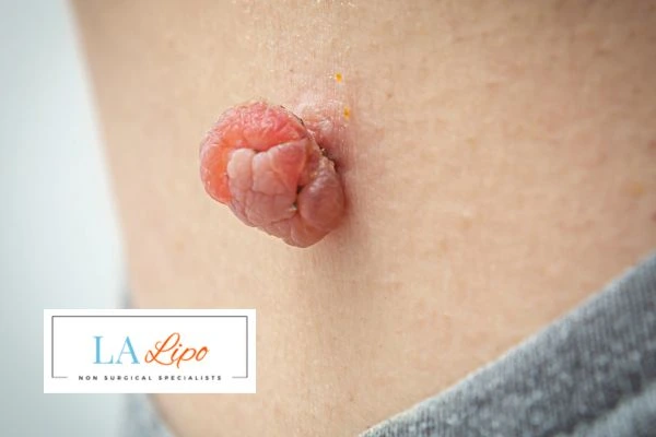 Interested in skin tag removal Solihull Lodge? Concerned about the pain? Find out more today!