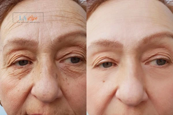 The powerful benefits of Morpheus8 Treatment Solihull Lodge - Call Our team today!
