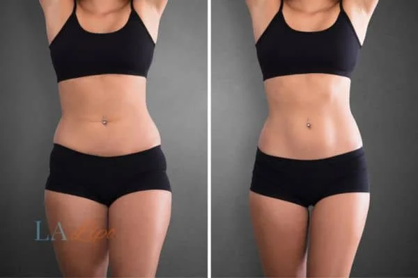 before and after results of non-surgical treatment to help a woman's body image and mental health Solihull Lodge