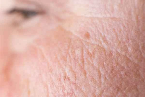 close up picture of a woman's face showing an age spot Solihull Lodge