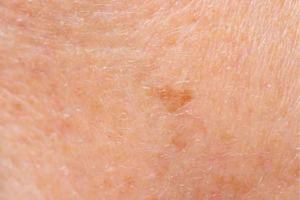 close up picture of age spots Solihull Lodge