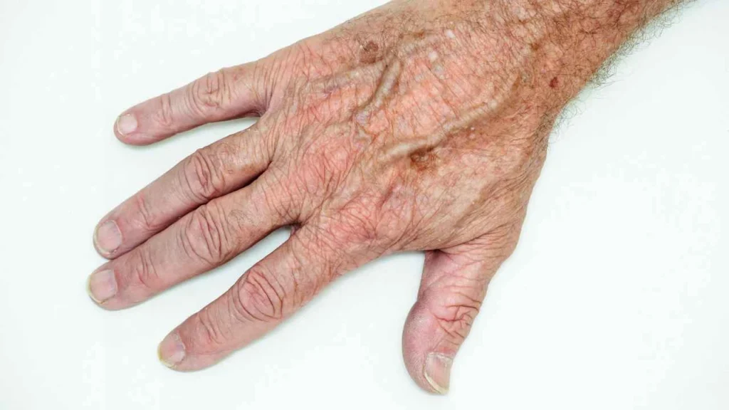 Male hand showing age spot Solihull Lodge
