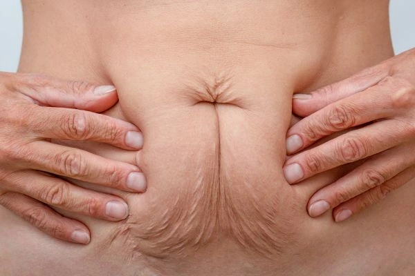 Image of a woman's stomach with loose skin - example of skin tightening Solihull Lodge options